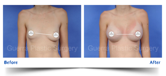 Nipple asymmetry before and after photo