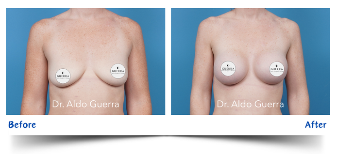 Real patient before and after photo 38453 by Dr. Guerra