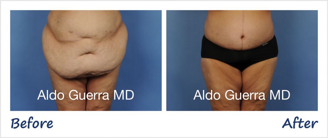 All About Fleur-De-Lis Abdominoplasty in Phoenix, AZ | Dr. Aldo Guerra