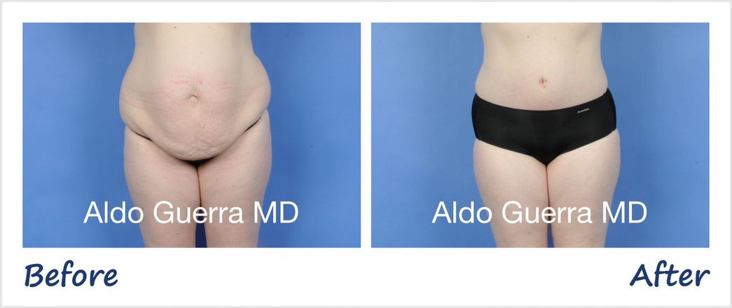 How does visceral fat affect a tummy tuck? | Guerra Plastic Surgery University