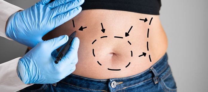 surgical markings for tummy tuck