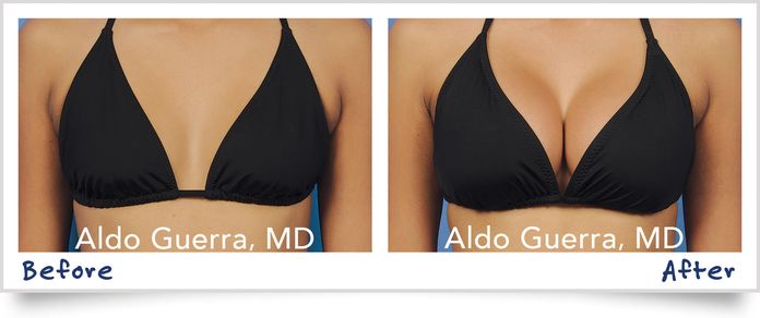 breast augmentation before and after bikini photo