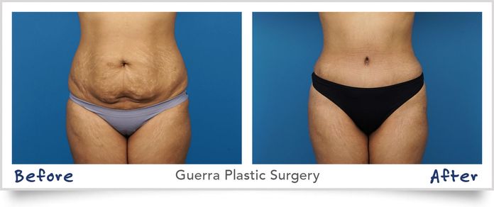 before and after Tummy Tuck with Lipo