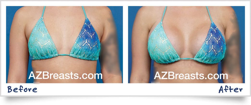 Choosing the Right Breast Implant Size | Guerra Plastic Surgery