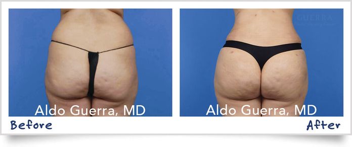 before and after photo liposuction