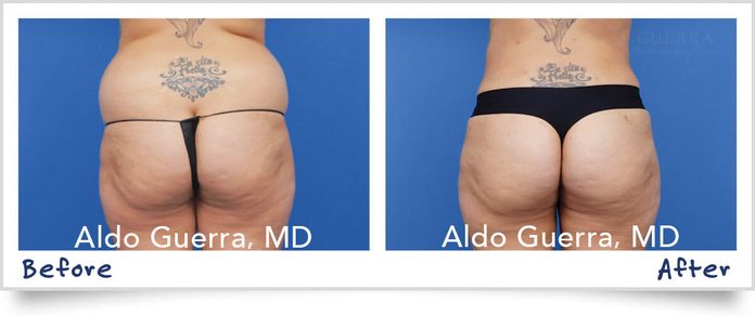 before and after liposuction photo