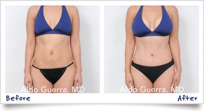 before after scottsdale mommy makeover