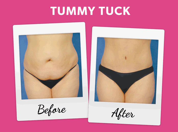 tummy tuck before and after animated photo