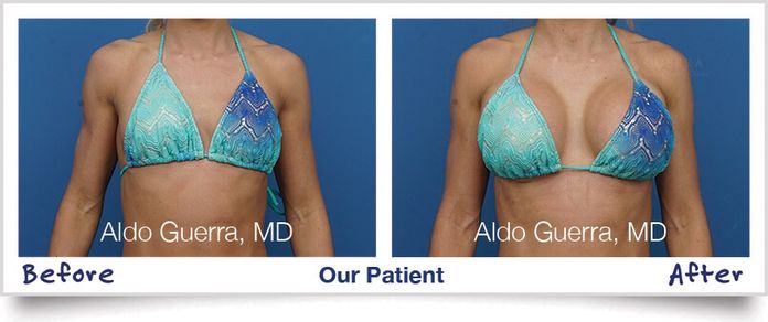 breast augmentation before and after bikini photo