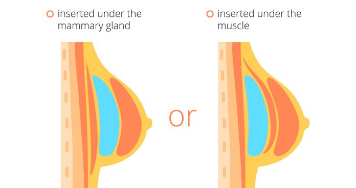breast implant placement diagram