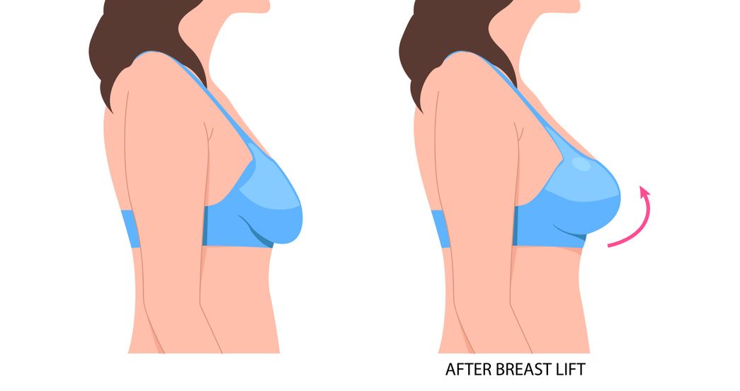 Spring Into Confidence: Why Breast Lifts May Rise Above Implants