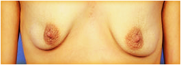 deflated breasts