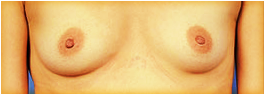 flat breasts