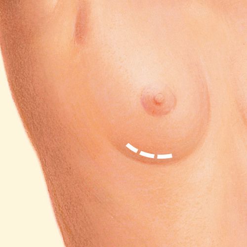 under the breast crease incision diagram