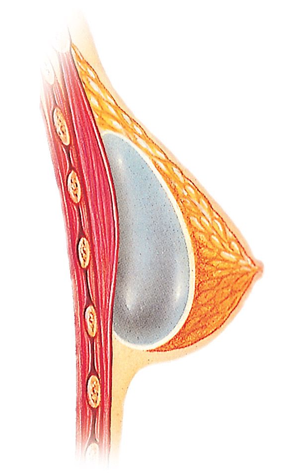 Diagram of implant over the muscle placement