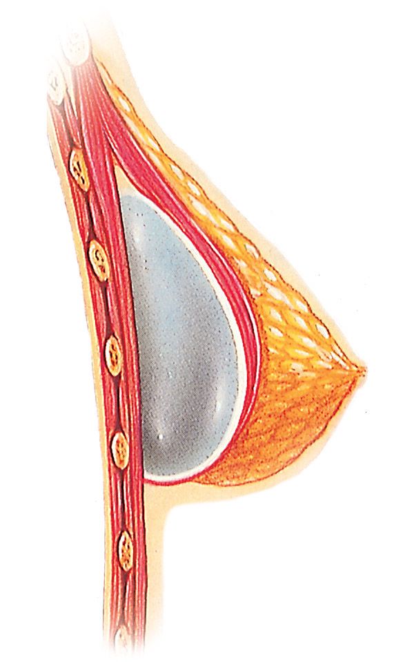 Diagram of implant under the muscle placement