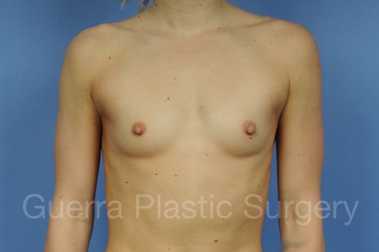 next Case #1002164 Before