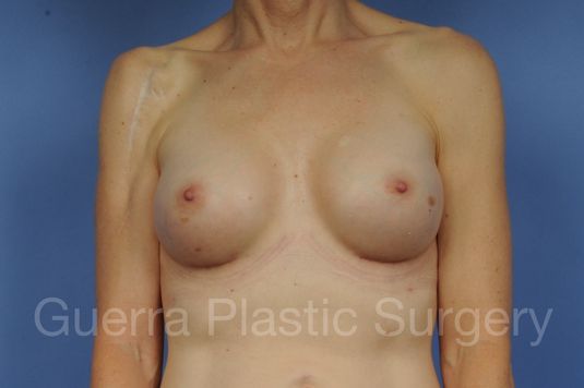 prev Case #1002161 After