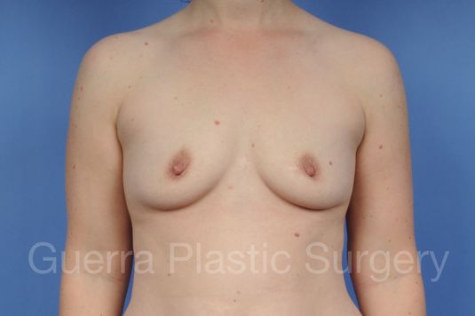 next Case #1002157 Before