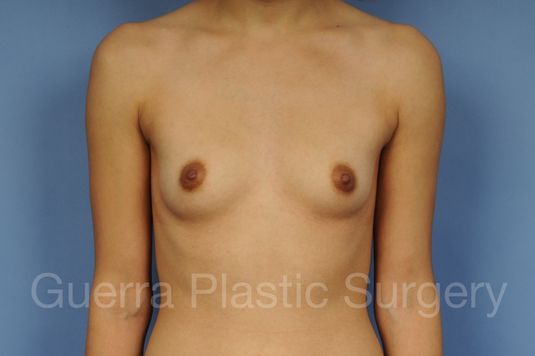 prev Case #10020173 Before