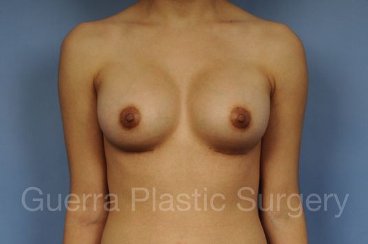 prev Case #10020173 After