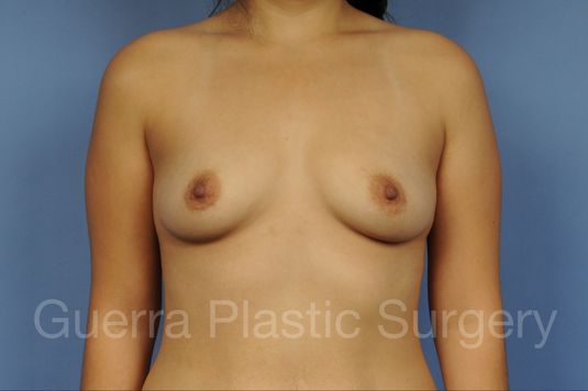 next Case #1002179 Before