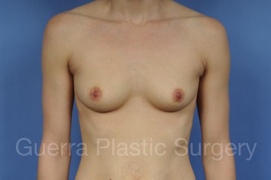 next Case #1001175 Before