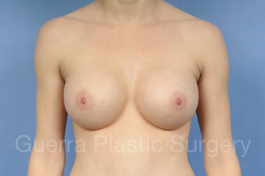 next Case #1001175 After