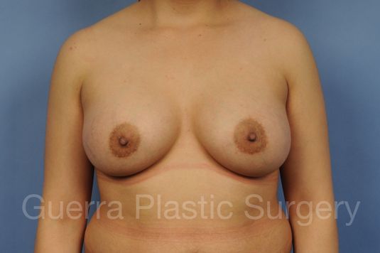 prev Case #1001177 After