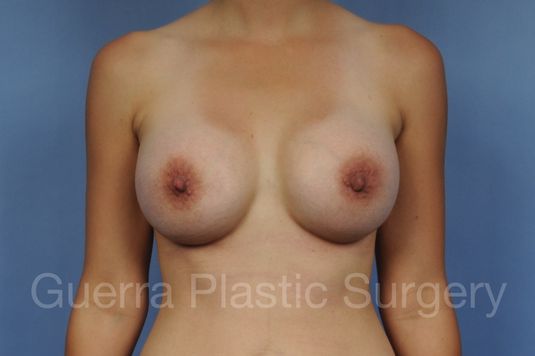 prev Case #1001178 After