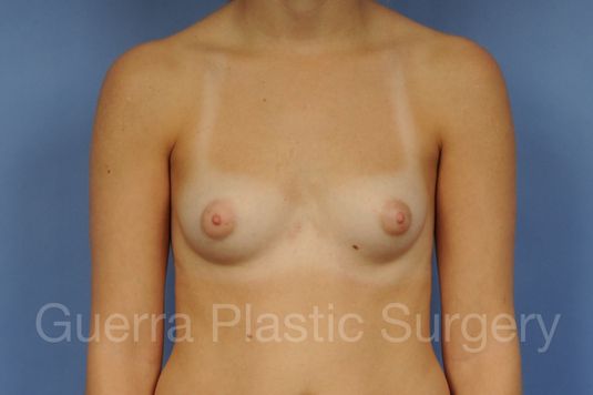 next Case #1001180 Before