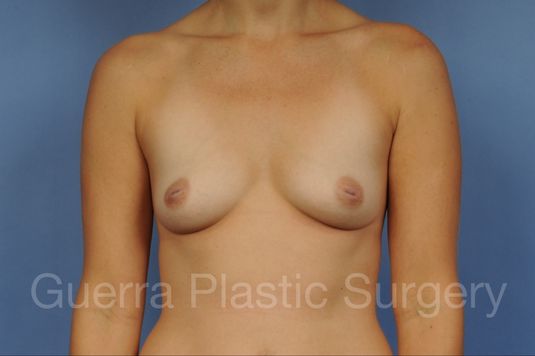 next Case #1005001 Before