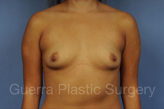 prev Case #10020171 Before