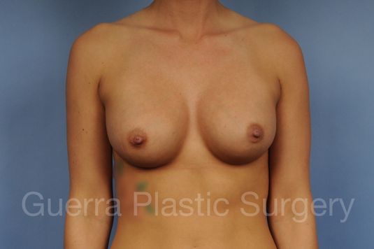 prev Case #1002041 After