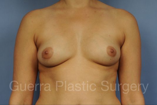 next Case #1002182 Before