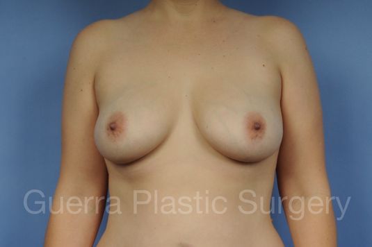 next Case #1002186 Before