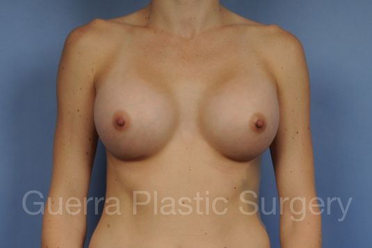 prev Case #1001183 After