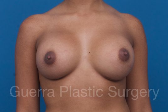 prev Case #1001191 After