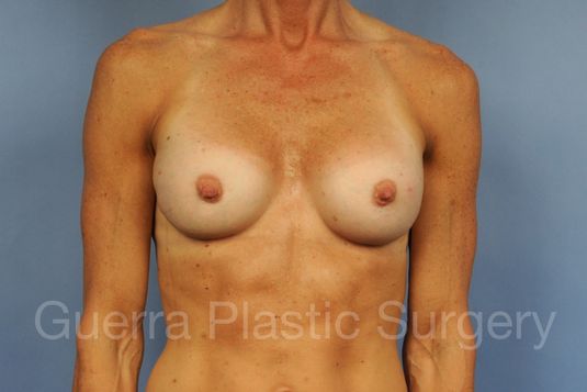 prev Case #1001193 After