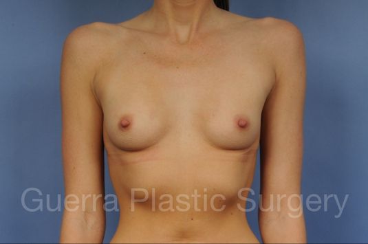 next Case #1001194 Before