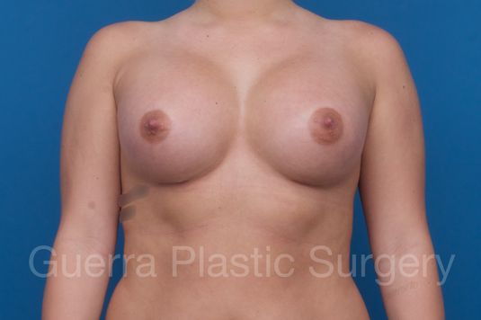 prev Case #1001204 After