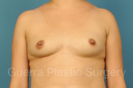 next Case #1001207 Before