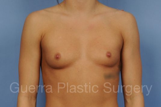 next Case #1001209 Before