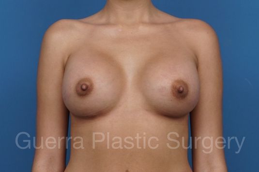 next Case #29290 After