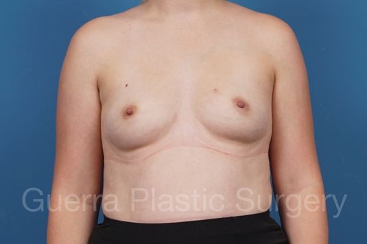 prev Case #35404 Before