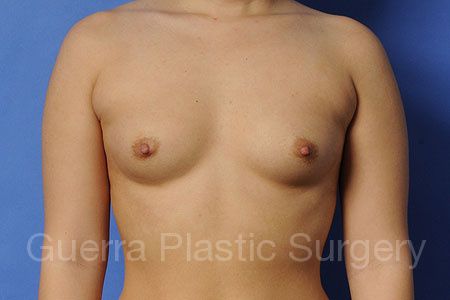 next Case #37231 Before