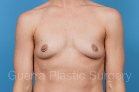 prev Case #38438 Before