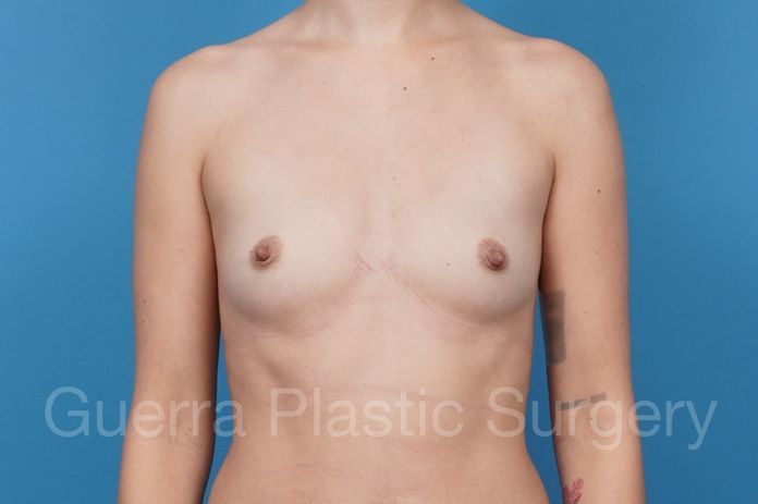 Breast Augmentation Case #41343 - before