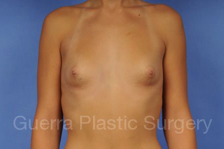 Before Photo Breast Augmentation