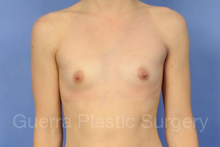 prev Case #96532 Before